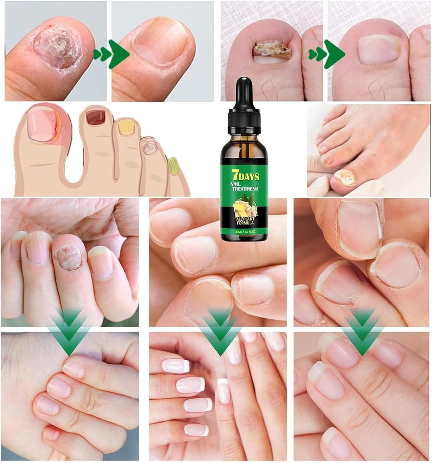 Ginger Nail Support Nail Care,Nail Strengthener for Damaged Nails,7 Days Nail Fungus Treatment,Toenail Cuticle Care Oil for Nails image number 4