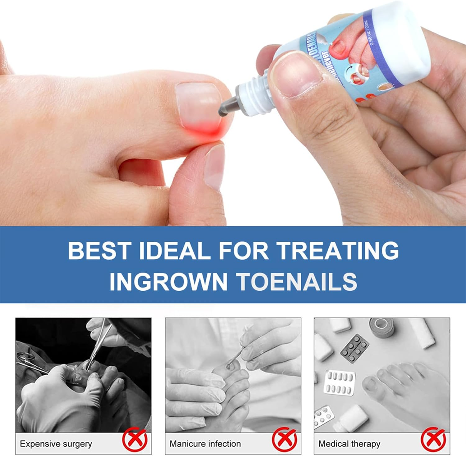 Ingrown Toenail Treatment - Ingrowing Toenail Treatments - Ingrown Nail Treatment for Toenails Extra-Strong image number 5