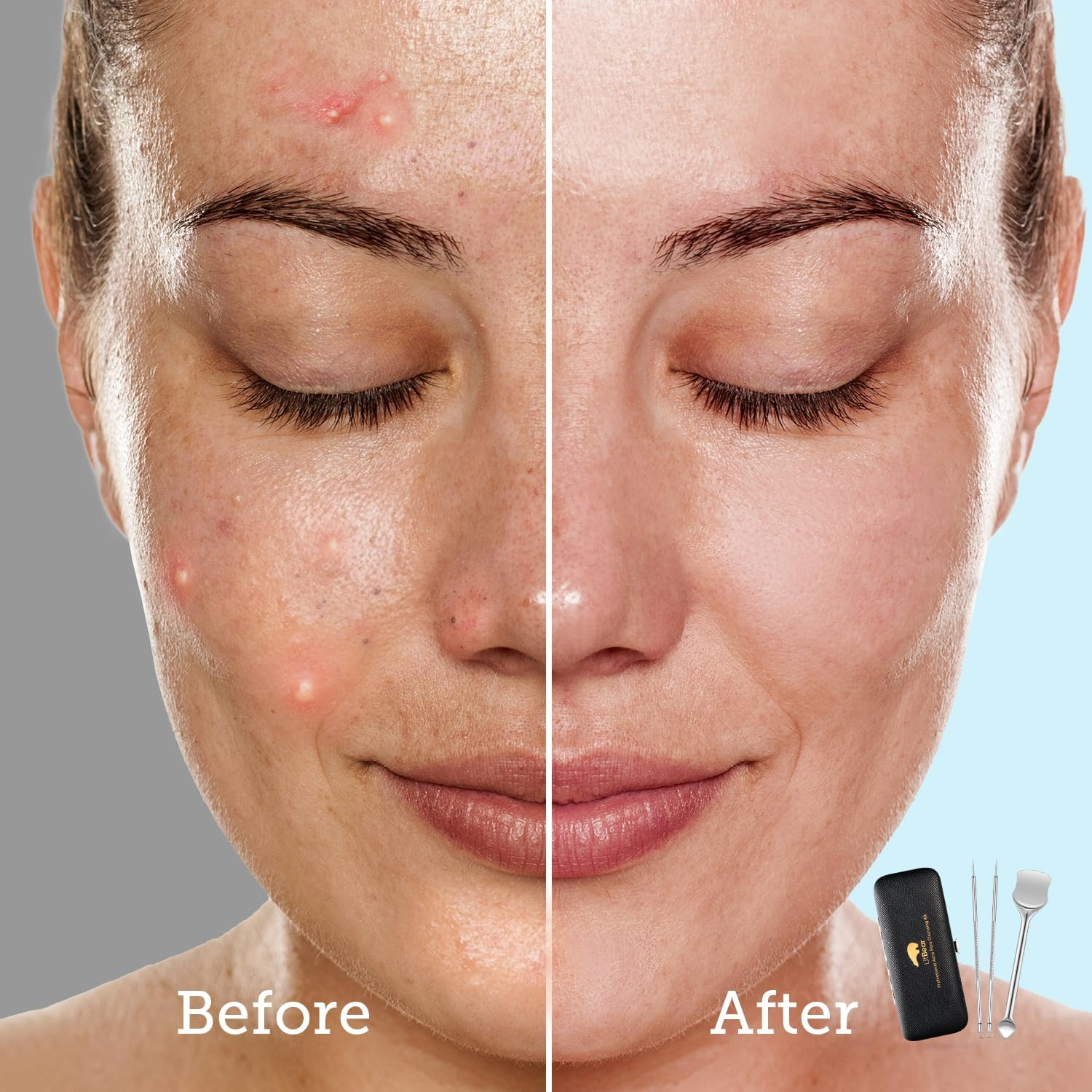 Litbear Pore Prep Tool, Blackhead Remover Pimple Popper Tool Kit, Stainless Steel Blackhead Extractions Tool for Acne, Whitehead Popping, Blemish, Comedone - Black image number 3