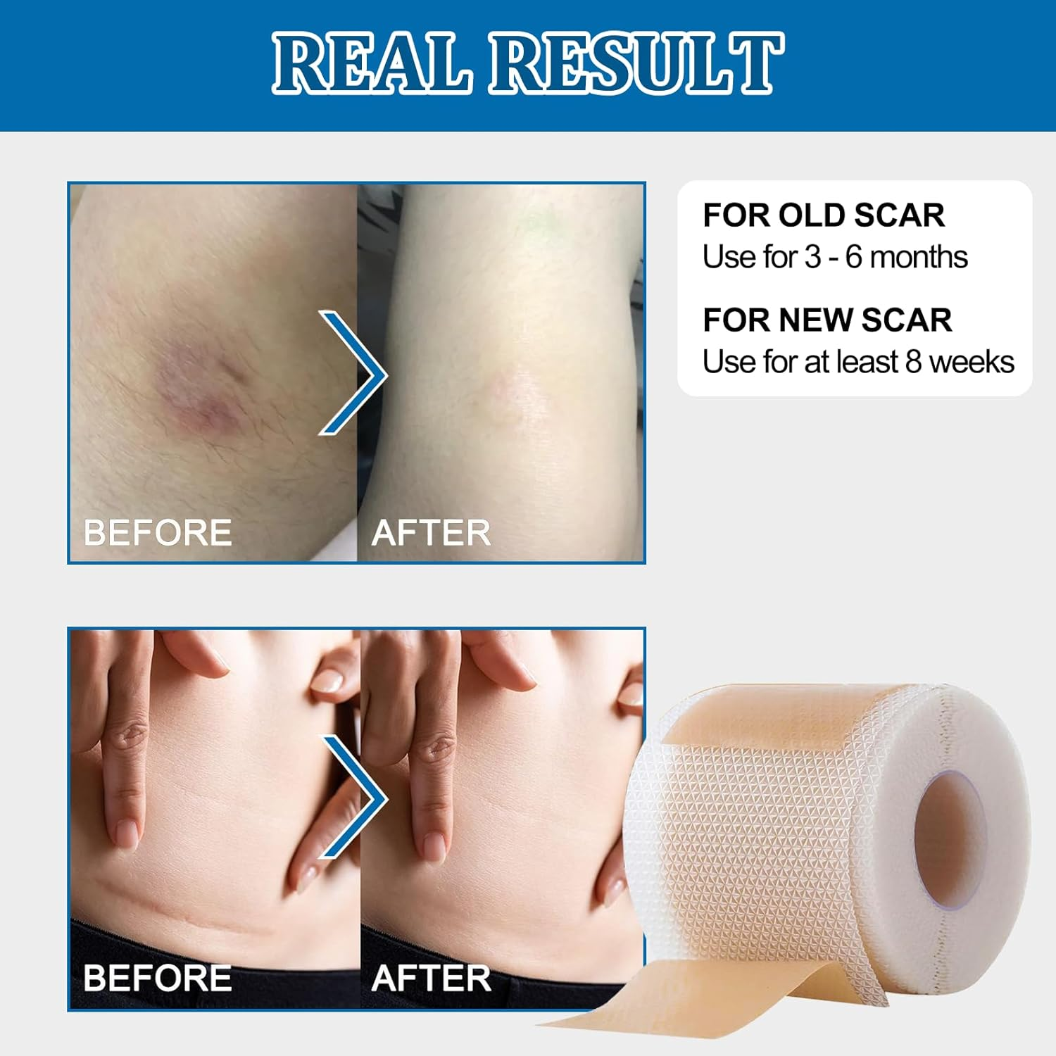 Silicone Scar Tape(3M - 1.6'' X 120''Roll) - Scar Removal Soft Silicone Scar Sheets Strips- Medical Grade, Reusable Gel Scar Tape for Keloid Surgery, C-Section, Acne and Burn image number 1