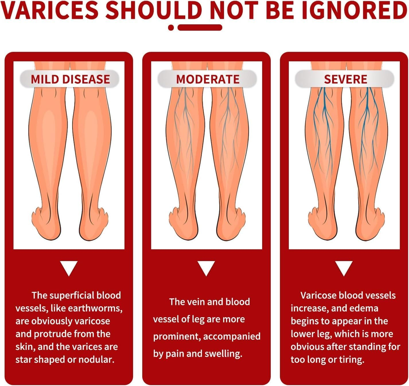 3 Pcs Medilisk Cream Varicose Veins,Medilisk Varicose Veins Relief Cream,Varicose Veins Treatment for Legs,Remove Varicose Veins, Improves Blood Circulation image number 1