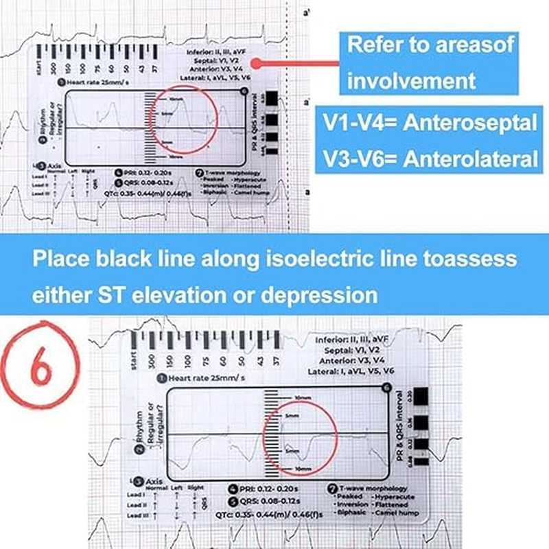 ECG 7Step Ruler,Ecg Ruler Plastic Ruler Measuring Tool,Ecg 7Step Ruler for ECG/EKG Interpretation,Transparent EKG Calipers 7Step Ruler,Follow a 7Step Plan ID Sized for Nurse or One in Healthcare (2) image number 1