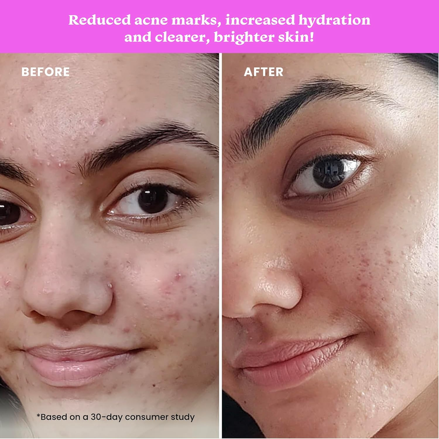 Foxtale 12% Niacinamide Face Serum with Azelaic Acid for Oil Control & Brightening | Reduces Acne, Blemishes & Acne Marks | Brightens & Smoothens Skin | Face Serum for Women & Men | 30 Ml image number 1