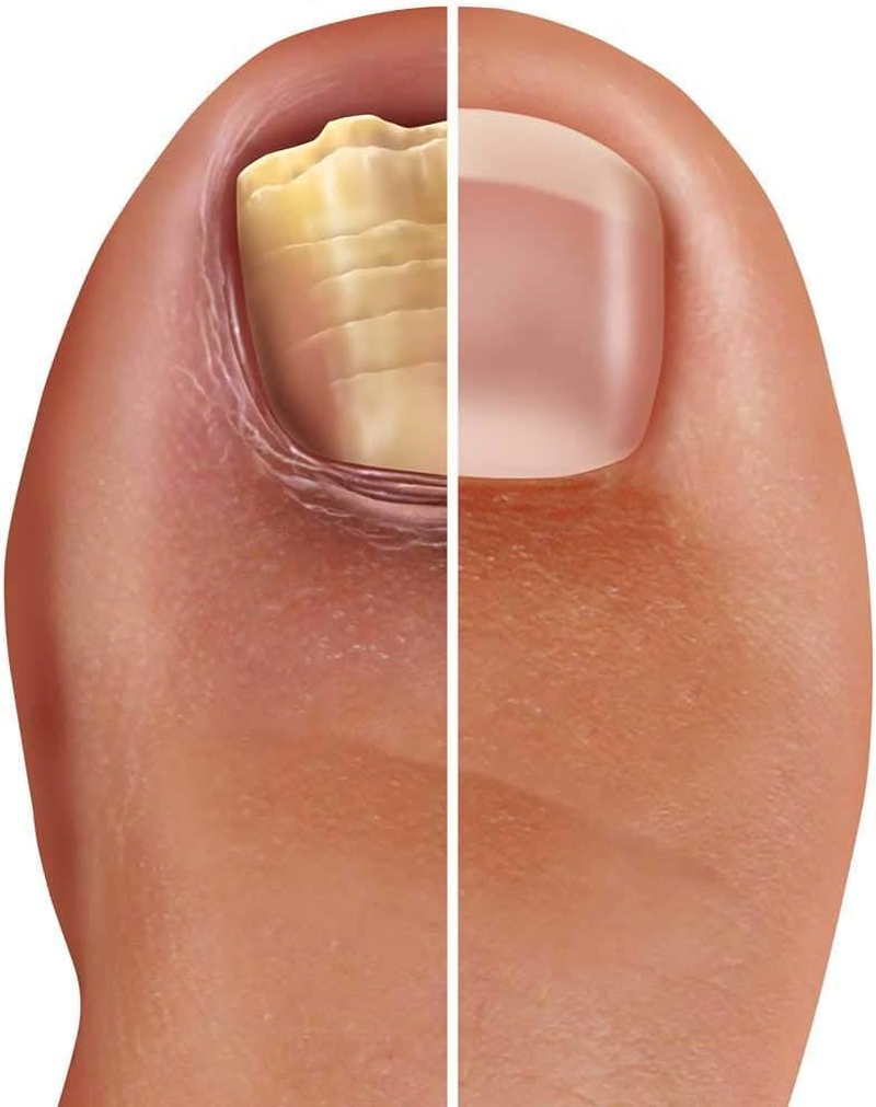 PRONAILPLUS FUNGAL Nail Solution 10Ml &ndash;TREATMENT for FUNGAL NAIL SOLUTIONS Pronail plus Treats Fungal Nail Infections Fast and Effectively image number 2