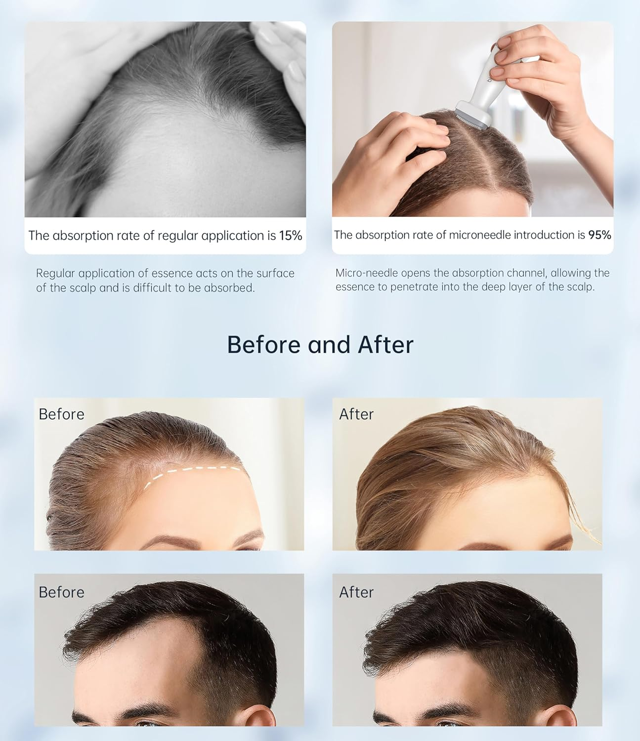 Ebeizi Adjustable Derma Stamp for Scalp Hair Beard Growth, 120 Real Needles from 0.25Mm to 2Mm, Professinal Microneedling Stamp Pen, Derma Roller Alternative for Face Body Home Use image number 2