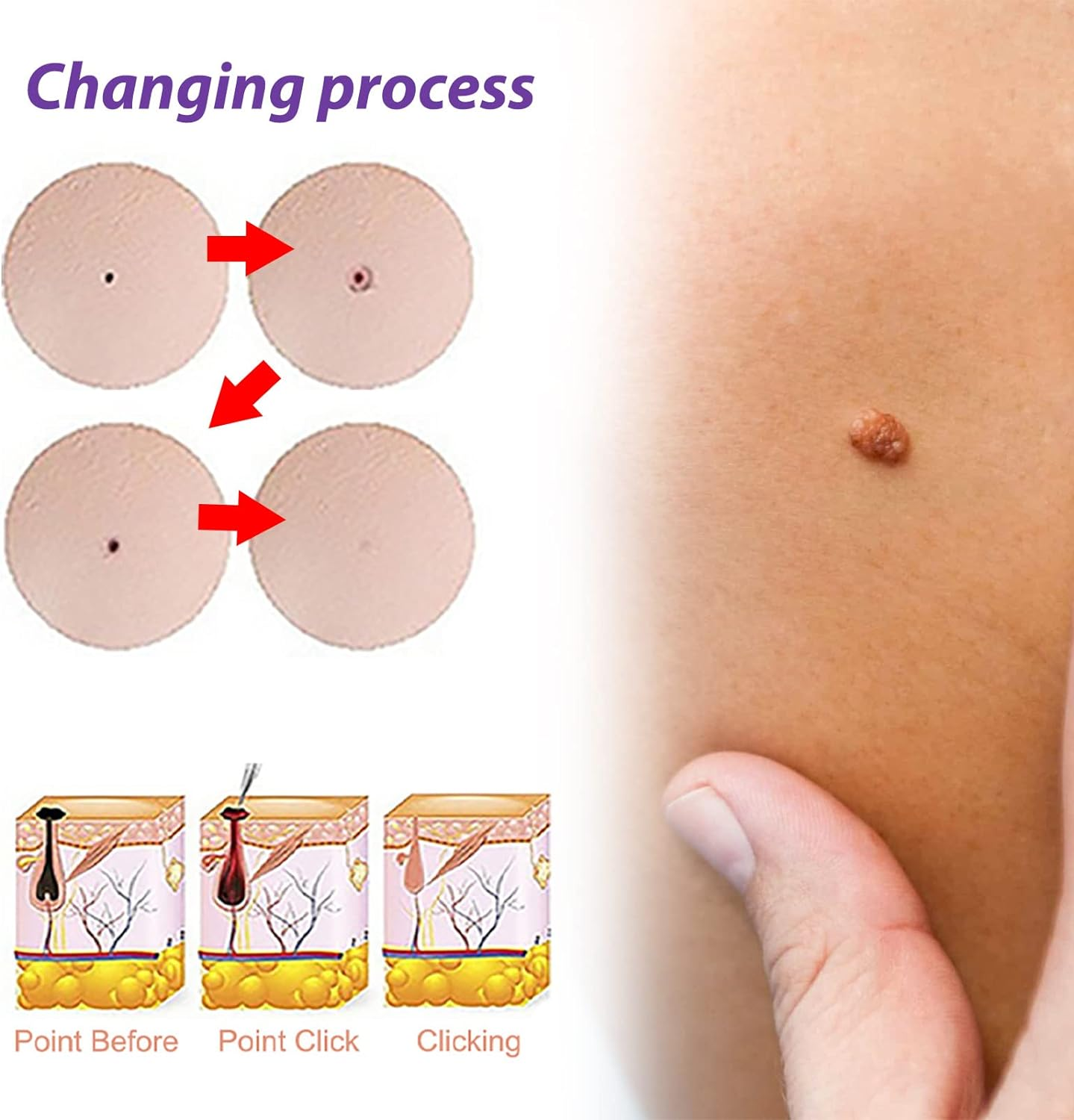 Skin Tag Remover - Professional Grade Fast Acting Liquid for Skin Tags, Moles & Warts Removal - Painless Treatment for Face & Body - 30Ml Easy Application Bottle image number 6