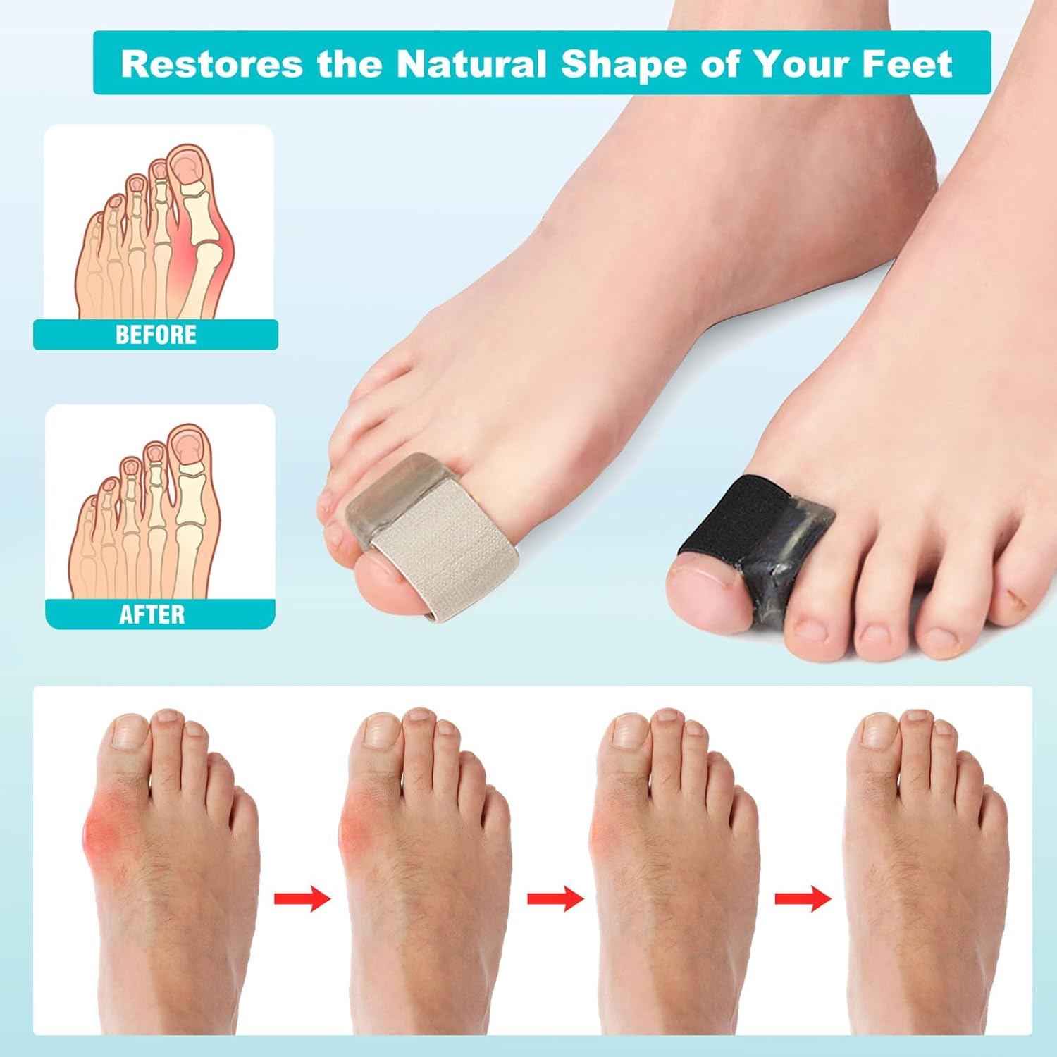 8 Pack Big Toe Spacer, Bunion Corrector for Women Men, Toe Separators for Overlapping Toes & Bunion Pain Relief