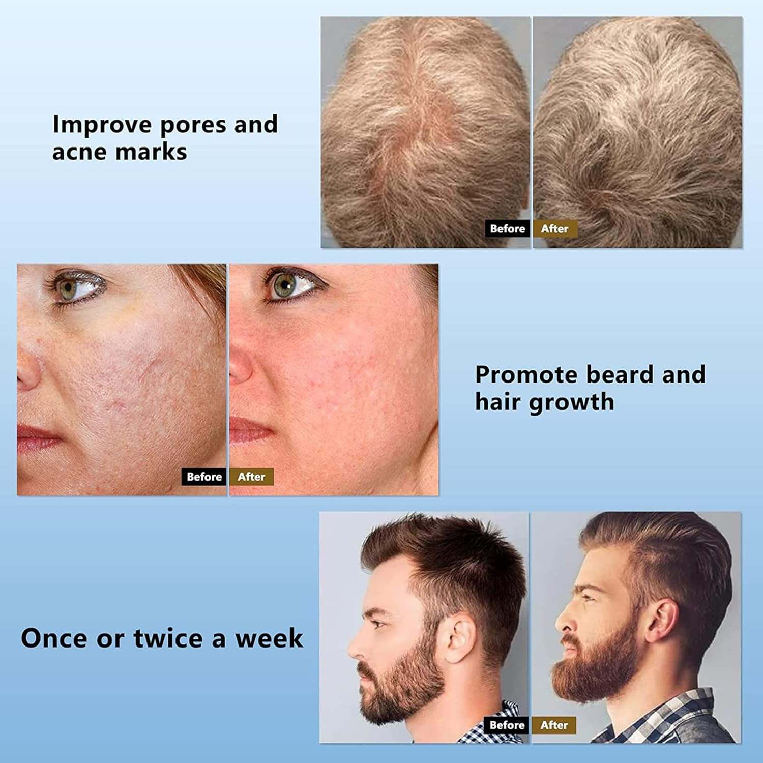 540 Titanium Microneedle Derma Roller Beard Microneedling Roller for Face Facial Wrinkles Hair Loss Stretch Marks Hair Regrowth Micro Needles with Case (2Mm) image number 2