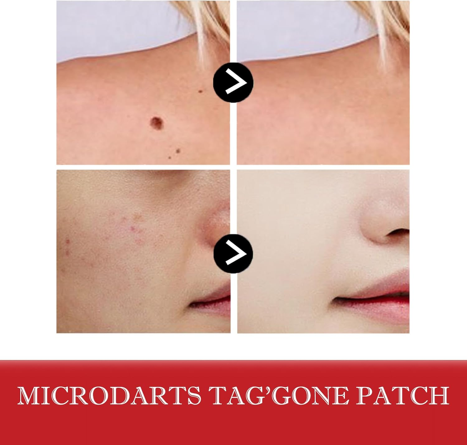 2 PCS Microneedle Skin Tag Patch - Safe & Gentle Plant-Based Pimple Patch for Face and Body &ndash; Waterproof Microdart Sticker for Quick Use Secure Fit Gentle for Various Skin Types (2 PCS) image number 2