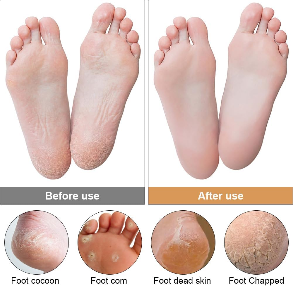 Alaoo Callus Remover, Callus Rasp, Foot File Pedicure, Callus Oble, Stainless Steel Foot File for Callus Removal, Dead Skin, File for Foot Care with Double Feet (Rose Gold) image number 3