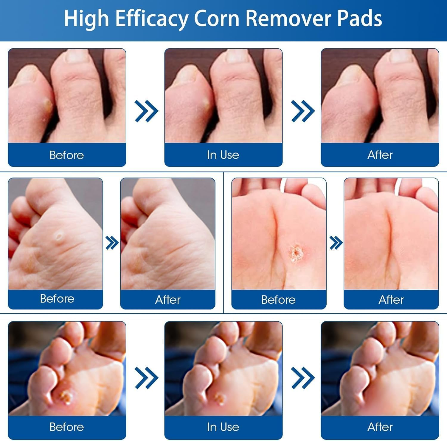 48 Count Corn Removal Pads for Feet and Toe, Corn Feet Remover for Extra Strength, Callous Remover image number 4