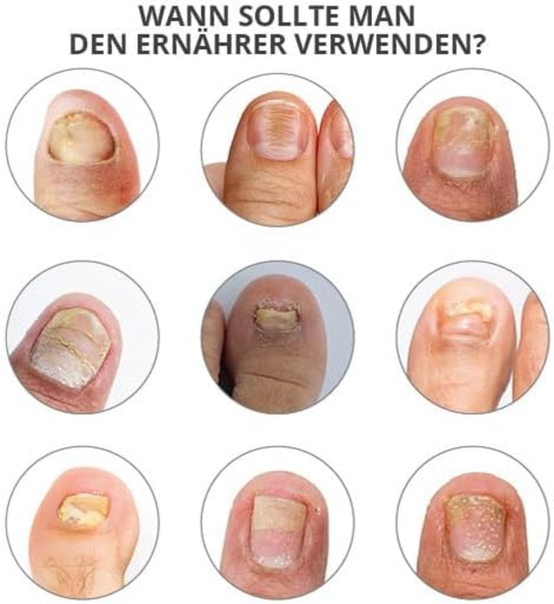 Grooved, Dry, Brittle Nails, 30 Ml, Ongles Abimes, Nourrissant Poderm Professional, 30 Ml