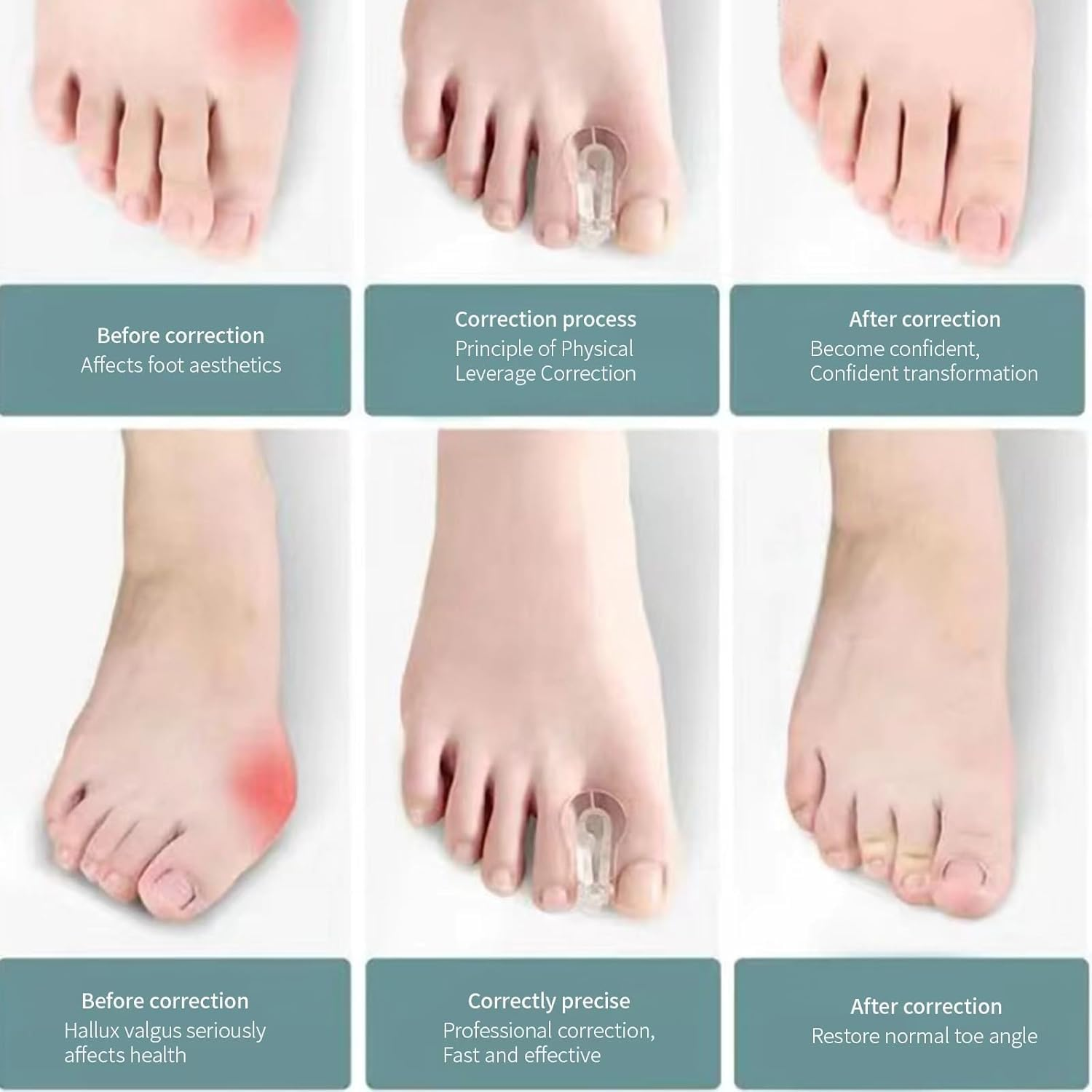 Memnun'S Soft and Highly Elastic SEBS Toe Separators, Hallux Valgus, Bunion,Hammer Toe, Overlapped Toe Corrector, Yoga Toe Separator, 10 Pieces image number 2