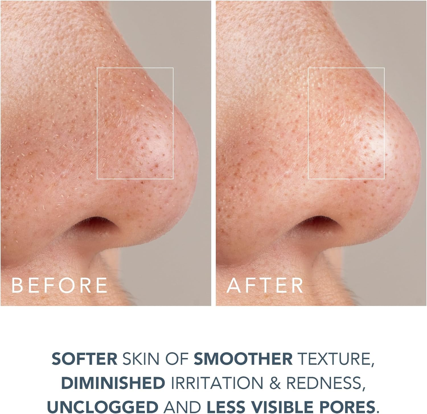 FOREO Smooth & Resurface KIWI Derma Microdermabrasion Machine - Black Head Remover for Face + KIWI Active Pore & Blackhead Mask, 100G - Blackhead Extractor - No Pore Strips Suction Blackhead Remover image number 5