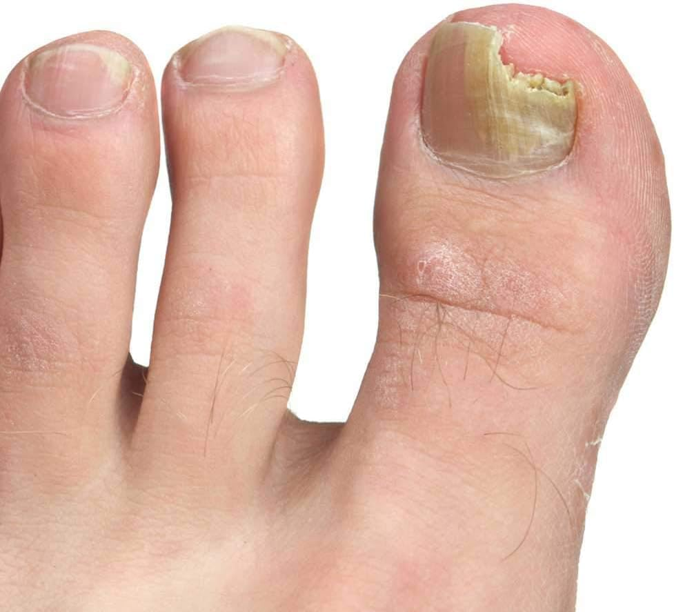 PRONAILPLUS FUNGAL Nail Solution 10Ml &ndash;TREATMENT for FUNGAL NAIL SOLUTIONS Pronail plus Treats Fungal Nail Infections Fast and Effectively image number 1