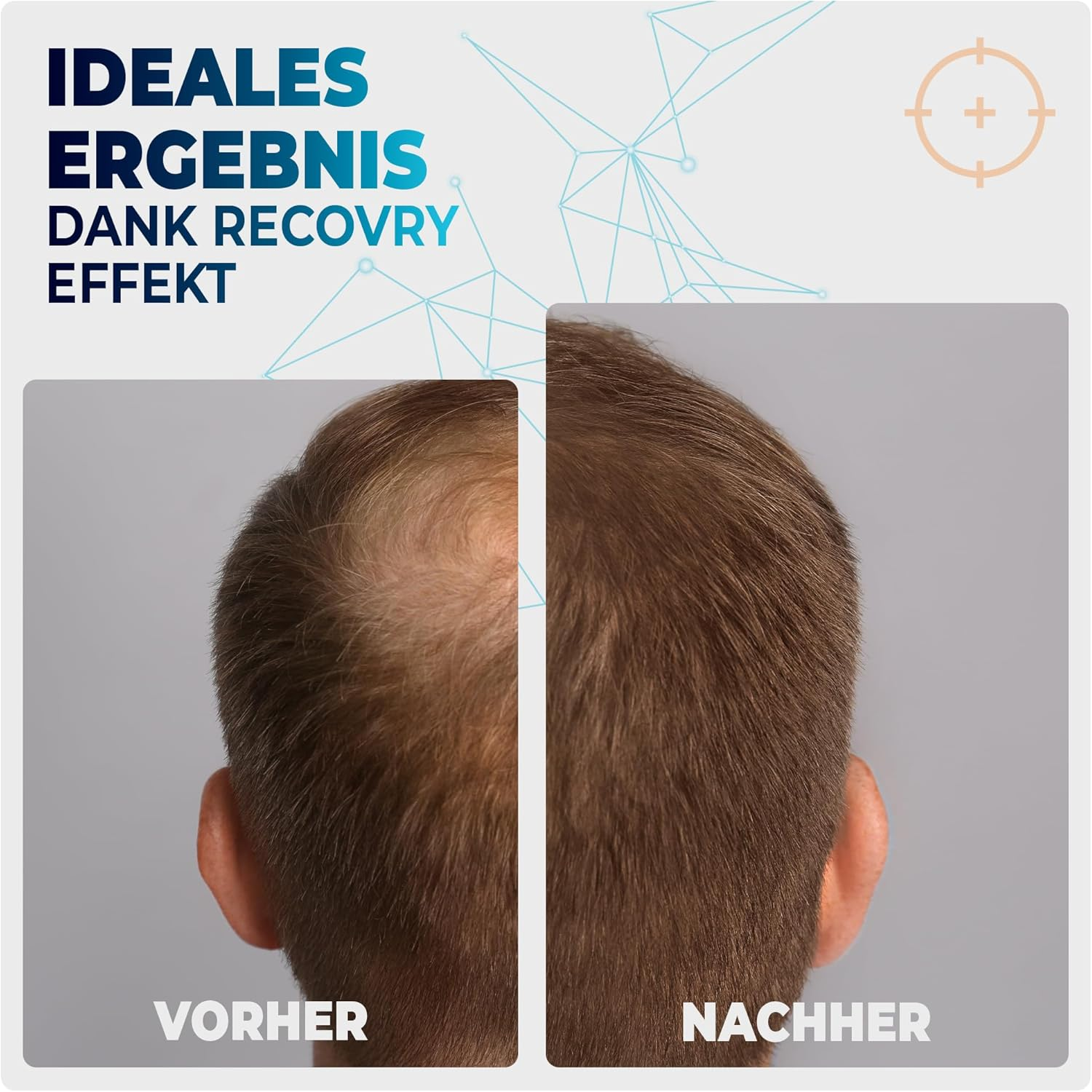 RECOVRY Derma Roller Men 1 Mm - 192 Real Needles for Maximum Hair Growth | Promotes Thick and Full Hair | Micro Needle Roller (Premium 1 Mm) image number 3