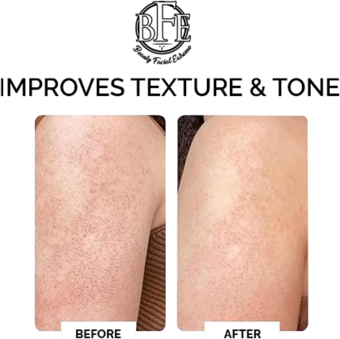 Exfoliating Body Lotion &ndash; 12% Lactic Acid Body Lotion. Provides Immediate Moisture & Gentle Exfoliation to Treat Symptoms Associated with Keratosis Pilaris & Dry Skin Conditions. image number 1