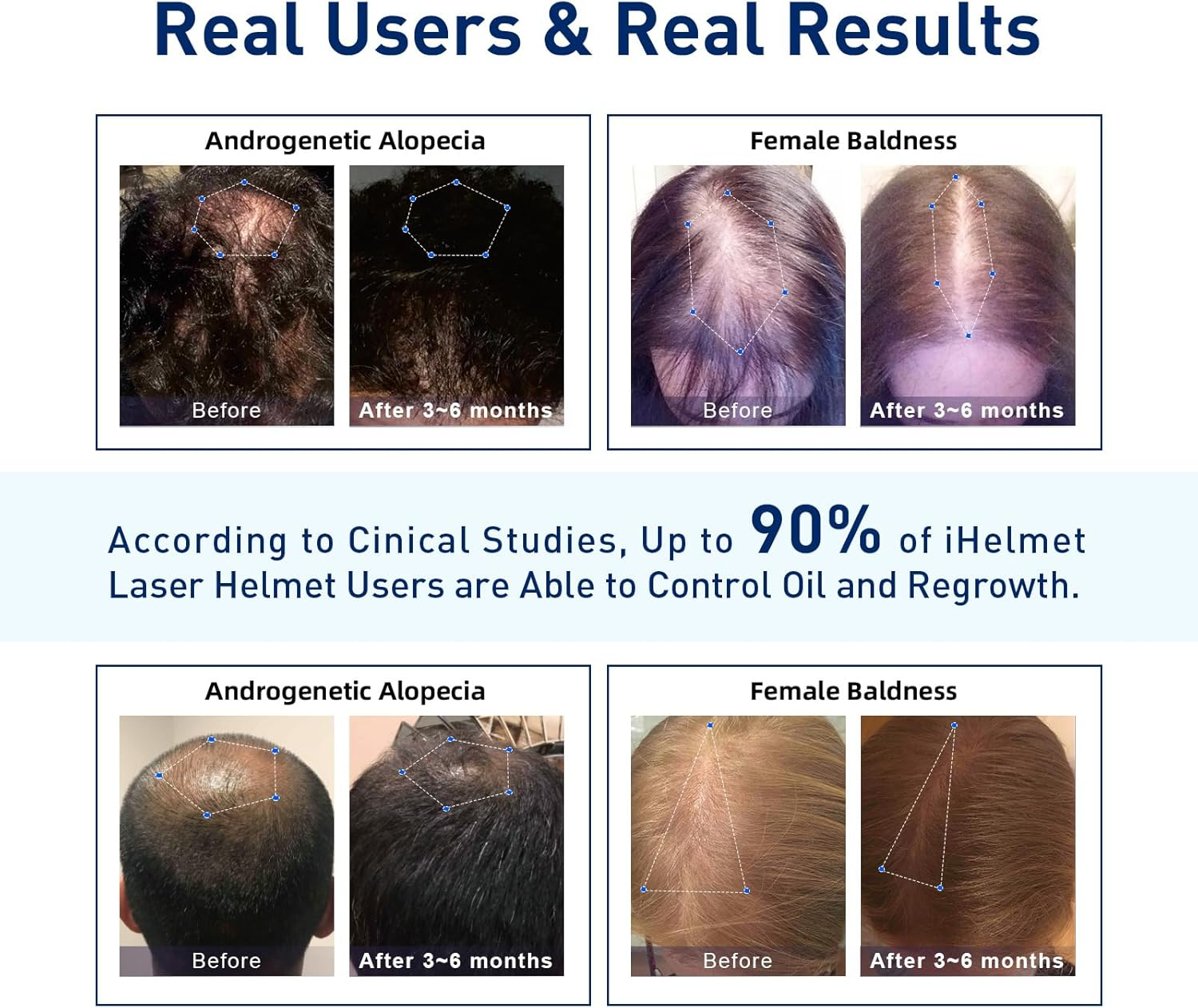 Laser Hair Growth System (FDA Cleared), Hair Regrowth Helmet & Laser Cap, Hair Loss Treatment for Men and Women, Low Level Laser Therapy for Hair Growth, Anti-Thining Treatment，36 Blue image number 1