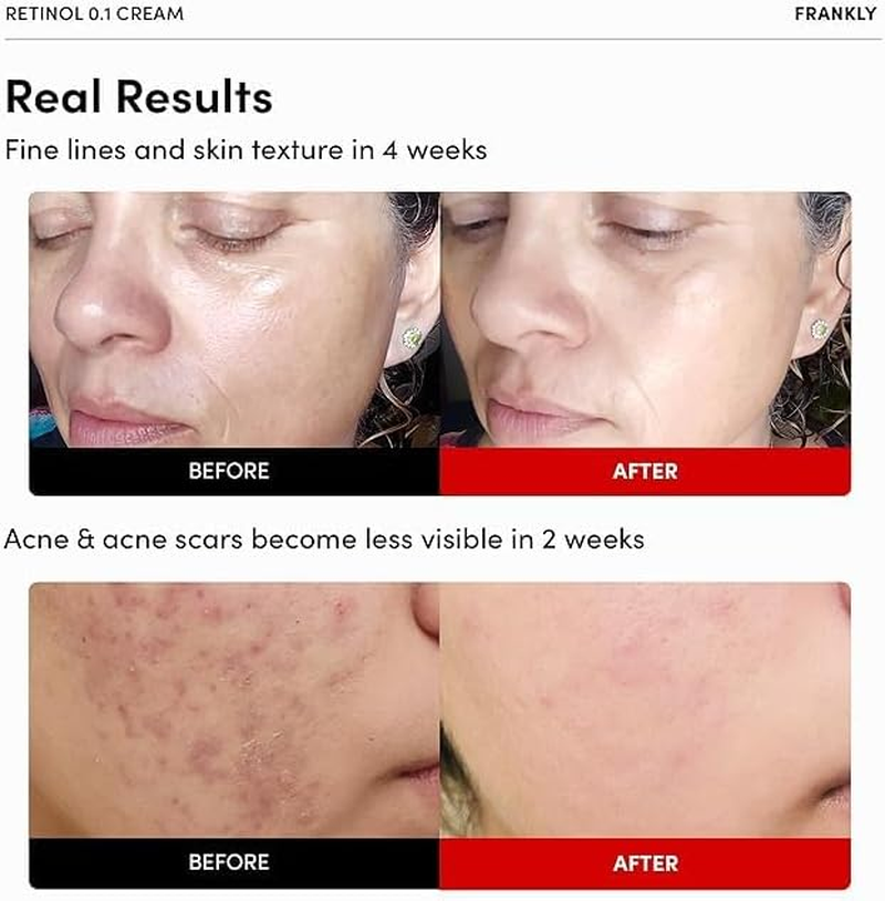 FRANKLY Retinol 0.1% Cream, 1.01 Fl Oz - Beginner Retinol | Night Cream | with Ceramides & Natural Ginseng | Anti-Aging, Wrinkles Care, Reduces Congestion and Hyperpigmentation | Korean Skin Care image number 3