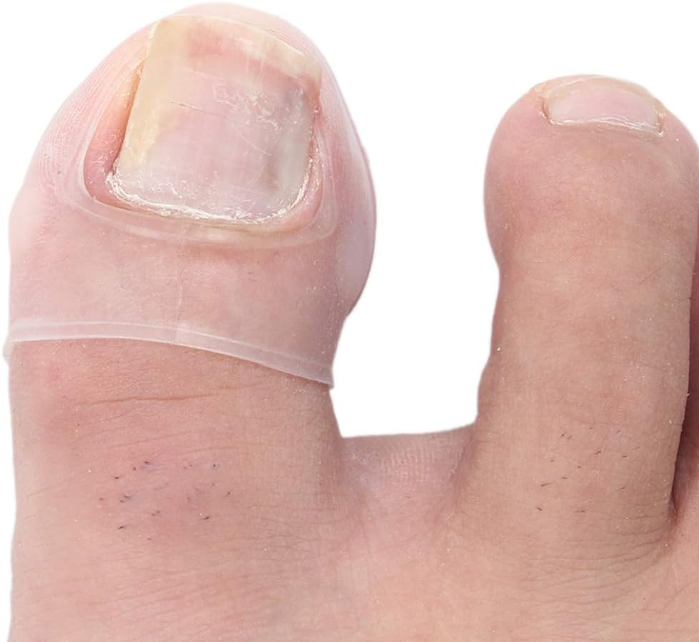 Ingrown Toenail Treatment, Silicone Foot Toe Protector Caps Ingrown Toenail Correcting Tool Pain Relief Paronychia Treatment Corrector for Men Women Pedicure Recovering Healing image number 3