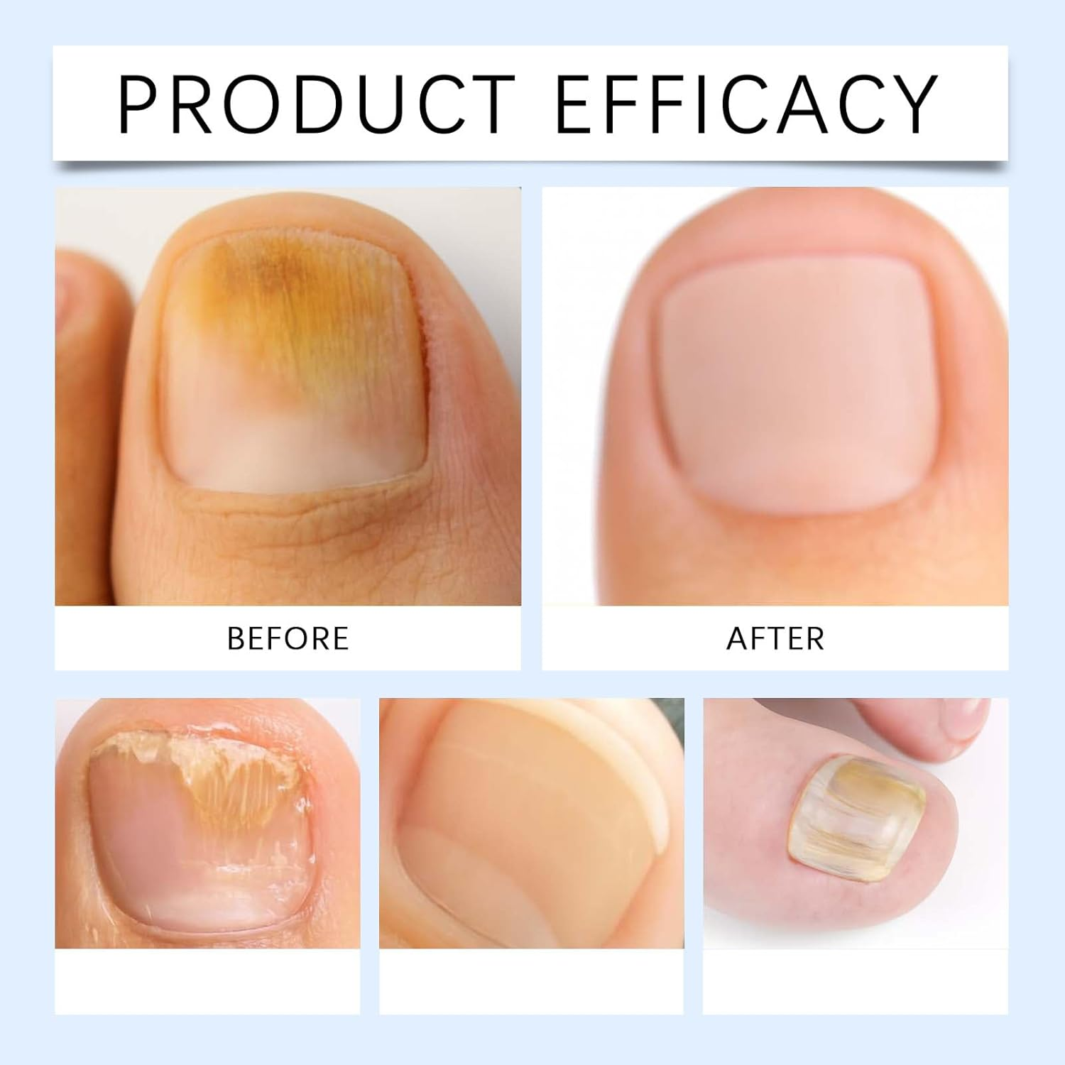 Hyaluronic Acid Nail Care, Nail Hardener for Weak Nails, Nails Strengthener for Dry Damaged, Nailes Growth Treatment Serum, Nailes Repair Growth Solution, Intense Moisture Treatment for Hydrated (2)