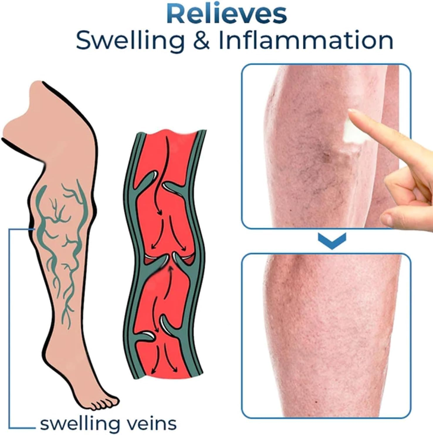 3Pcs GFOUK Mucopolysaccharide Polysulfate Cream,Varicose Veins Cream,Varicose Veins Treatment for Legs,Removal Spider Veins Improve Blood Circulation image number 1