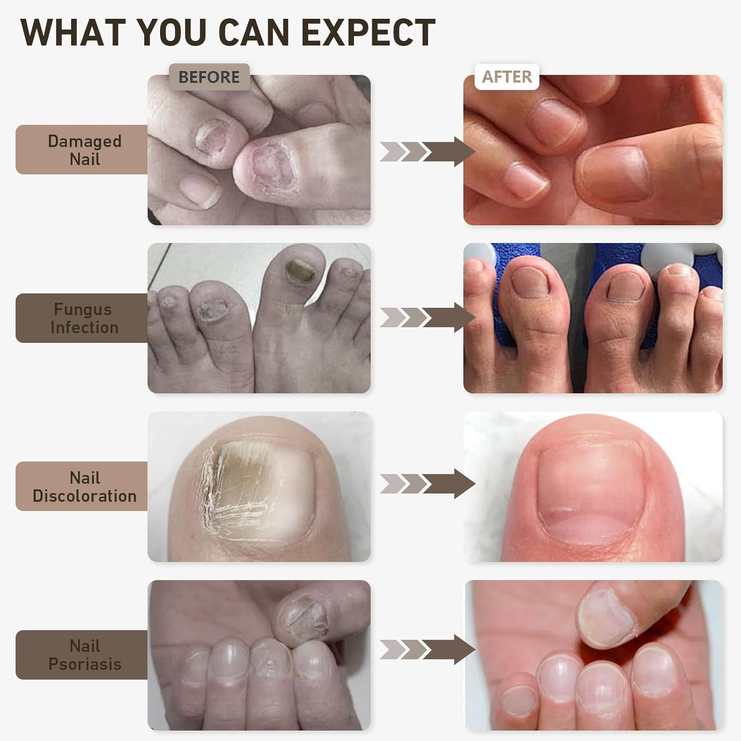 Ikeener Nail Fungus Treatment Device for Multiple Toenail, 15*470Nm Blue Light & 42*650Nm Red Light Fungal Nail Treatment Device with Adjustable Time, Natural Antifungal Laser Nail Treatment at Home image number 3