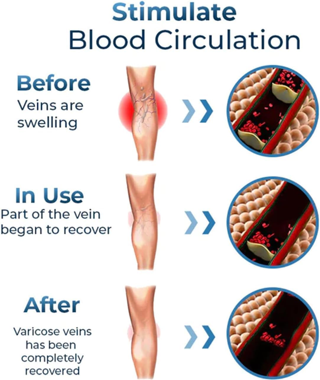 3Pcs GFOUK Mucopolysaccharide Polysulfate Cream,Varicose Veins Cream,Varicose Veins Treatment for Legs,Removal Spider Veins Improve Blood Circulation image number 2