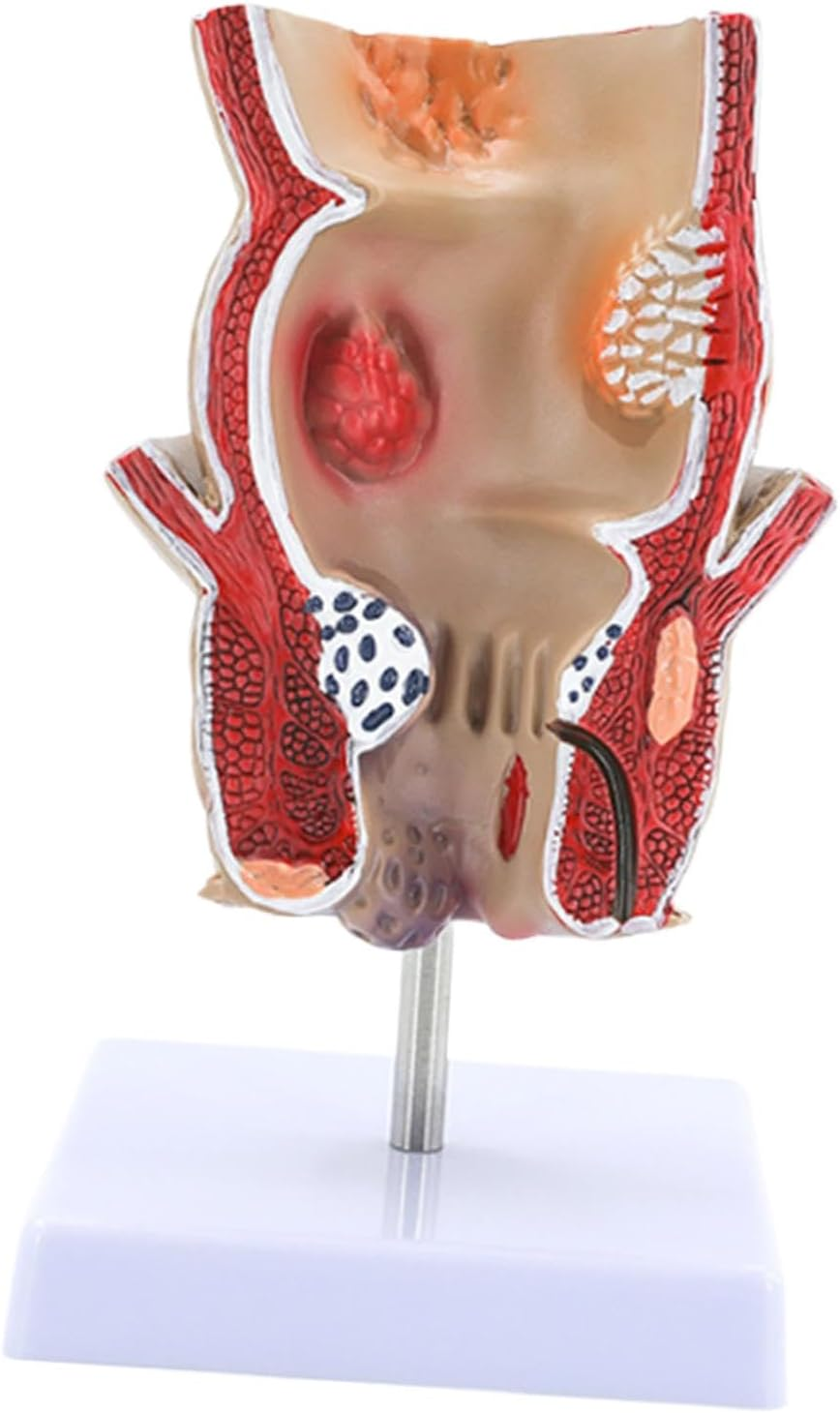 Eigell Human Pathology Rectal Model Educational Display Tool for Study School image number 4