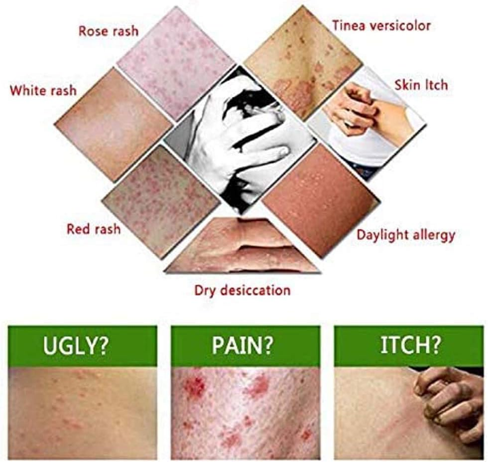 Chinese Herbal Eczema Cream, Anti-Itch Cream, Psoriasis Creams, Dermatitis and Eczema Pruritus Psoriasis, Natural Herbal Chinese Eczema Cream for Adults Kids (4PCS) image number 4