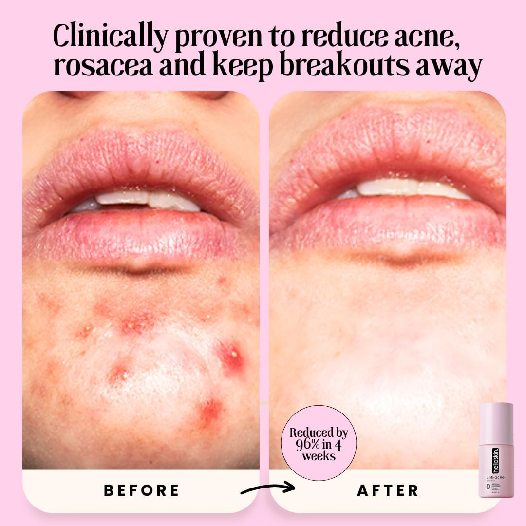 Azelaic Acid 20% & Niacinamide 10% | Helloskin anti Acne Serum (30Ml) | Face Serum for Acne Marks and Rosacea Clears Rosacea | Kills Acne | Men and Women Daily Serum for Clear Smooth, Radiant, Glowing Skin