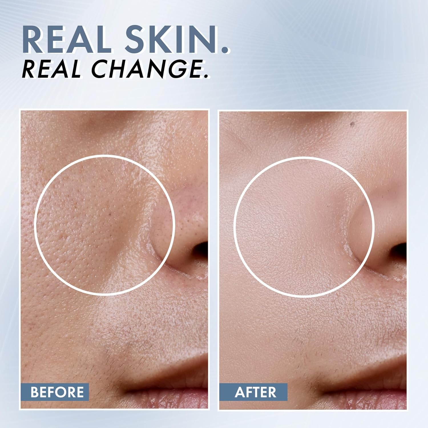 Thriveco Niacinamide Serum with Zinc PCA | Reduces Acne Marks & Blemishes | Minimizes Pores | Oil Control Face Serum for Oily Skin | for Men & Women | 30Ml image number 5