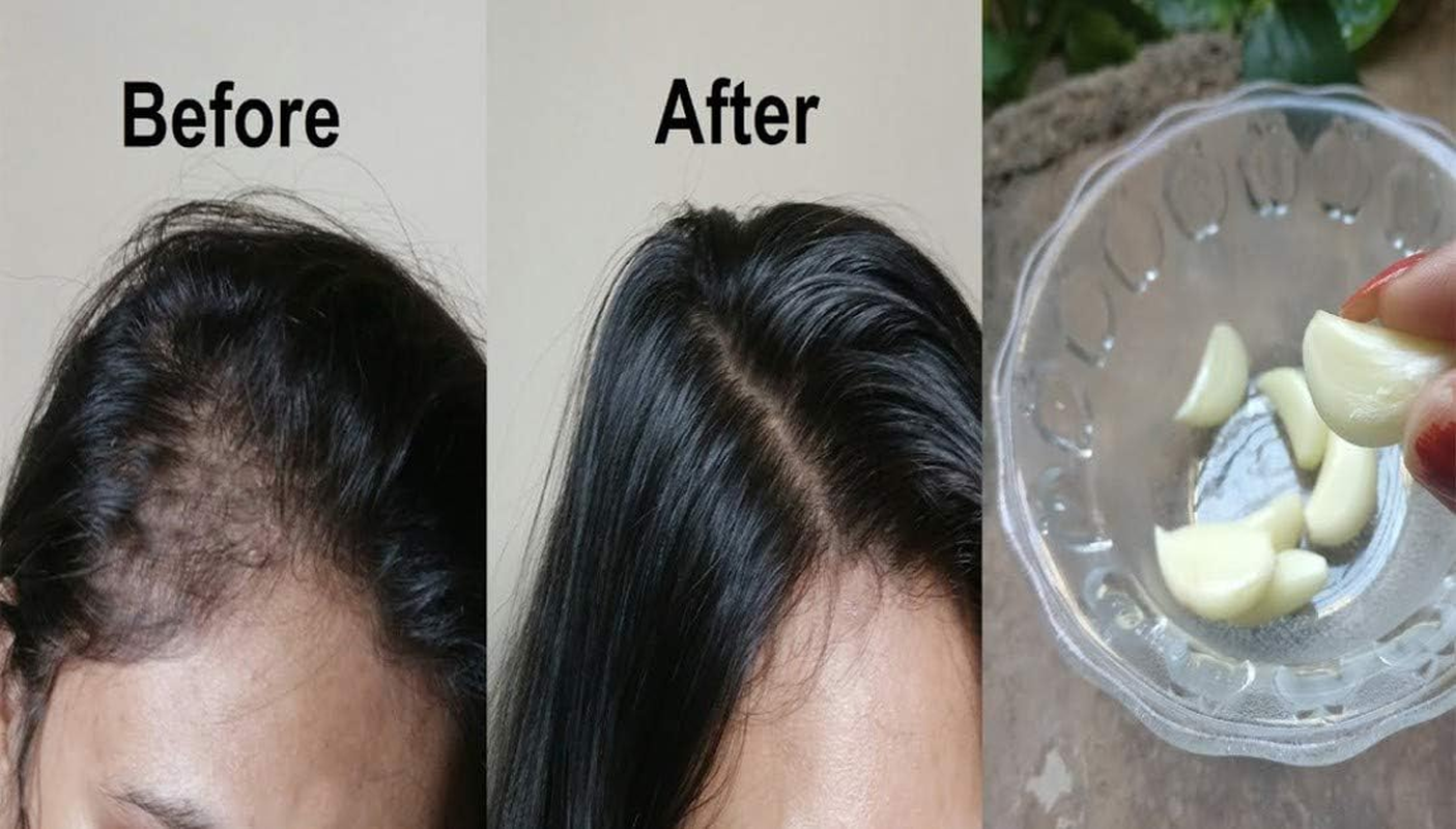 Dominaro 100 % Pure & Natural Red Onion Oil & Garlic Oil (Combo Pack of 2 Bottle ) 200 Ml Hair Oil (200 Ml)