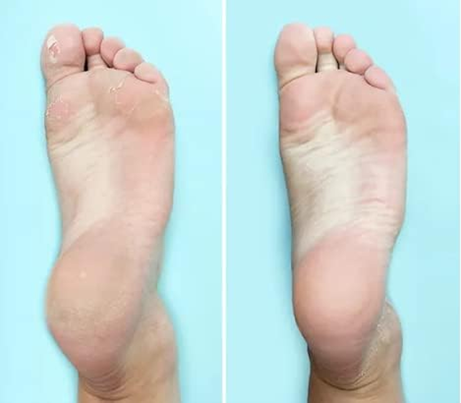 Ever Ready Corn & Callus Trimmer Refills X 4 - - Instant Relief from Corns | Removes Dry, Hard & Cracked Skin | Home Pedicure Treatment for Footcare image number 5