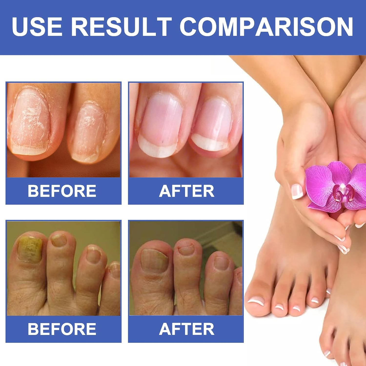 Fungal Nail Treatment - Fast-Acting Solution for Thick, Discolored Toenails &ndash; Revitalize Yellow & Brown Nails with Our Powerful Formula &ndash; Quick, Effective Relief for Beautiful Nails image number 4