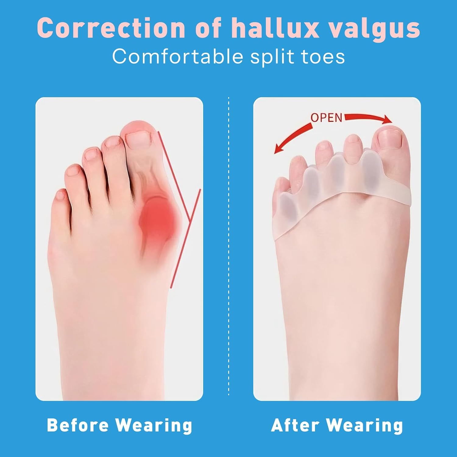 Toe Separators and Spacers, 4 Pairs of Soft Gel Toe Spreaders for Bunion Correction and Foot Pain Relief, Toe Stretchers Suitable for Men and Women, Ideal for Hammer Toes, and Claw Toes, Blue/White image number 3