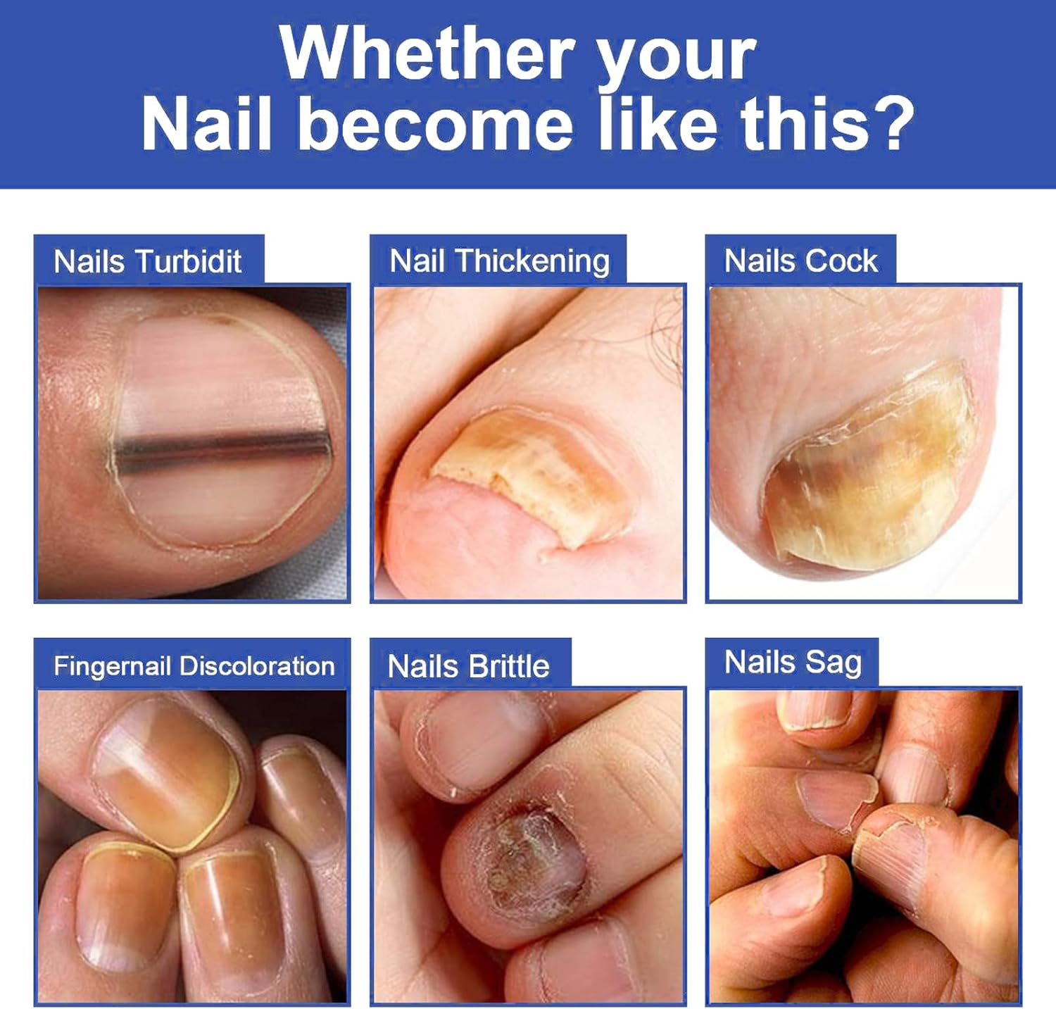 Fungal Nail Treatment - Fast-Acting Solution for Thick, Discolored Toenails &ndash; Revitalize Yellow & Brown Nails with Our Powerful Formula &ndash; Quick, Effective Relief for Beautiful Nails image number 1