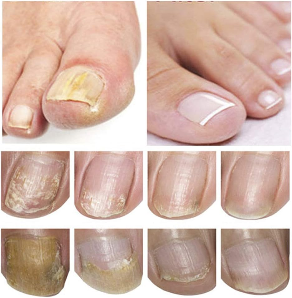 Nail Care and Treatment, Nail Care for Healthy Foot and Hand, Nail Care Oil, Nail Care image number 5
