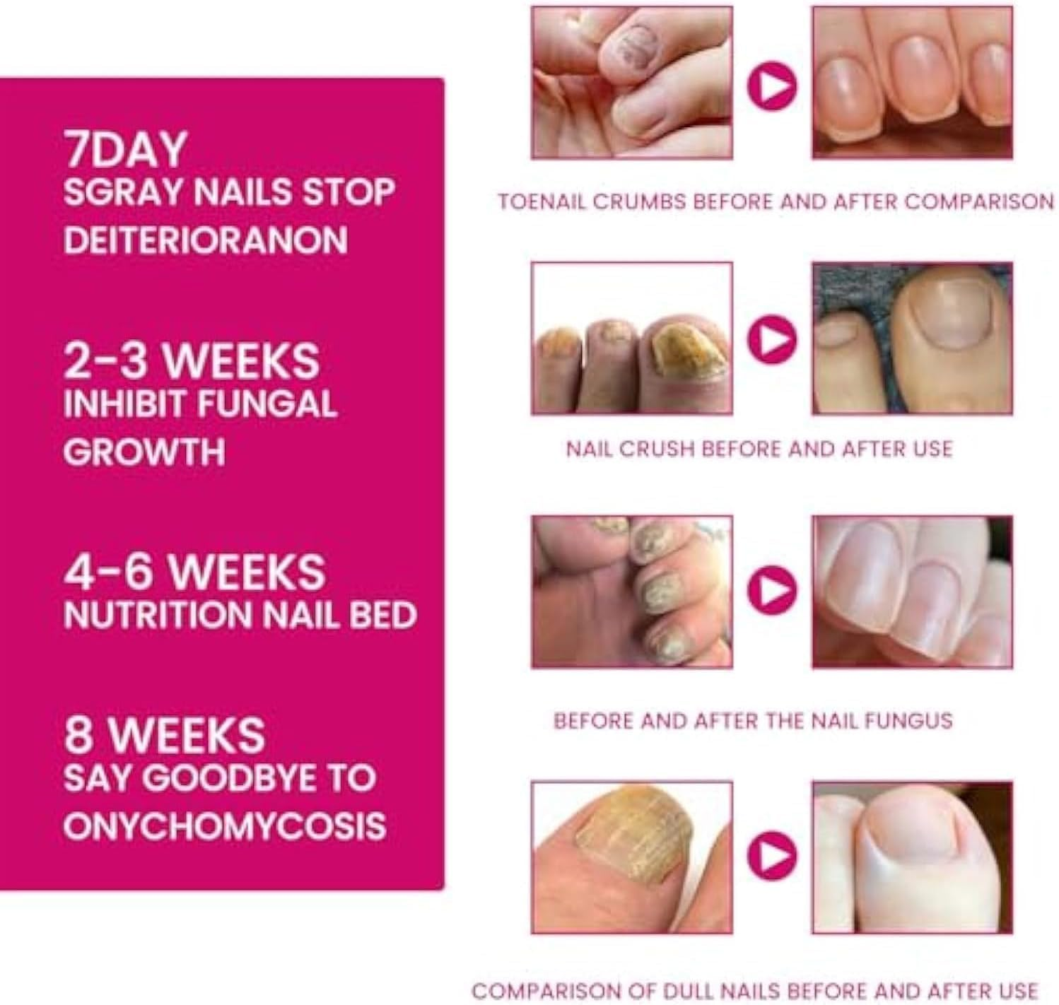 Fungigone Nail Treatment, Fungigone Nail Fungus Removal, 7 Days Nail Fungus Treatment for Toenail, Foot F-Ungus Treatments Nails Care Solution for Toenails & Fingernails (3 PC) - 2 Pc image number 3