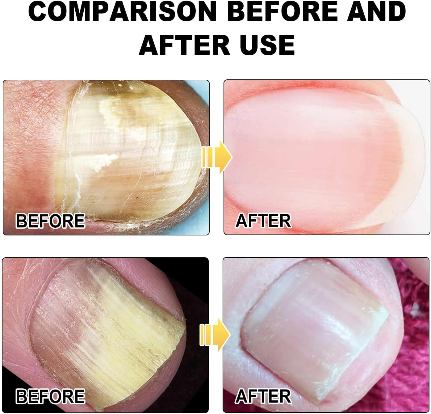 30ML Fungal Nail Treatment for Toenails & Fingernails to Improves Brittleness & Discoloration, Nail Tending for Stronger, Healthier-Looking Nails image number 3