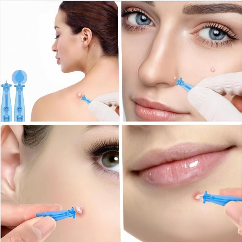 Blue Blackhead Remover Needles, 50Pcs Blackhead Acne Pimple Popper Needles, Acne Pimple Popper Needle Remover Tools for Women Home Use image number 5
