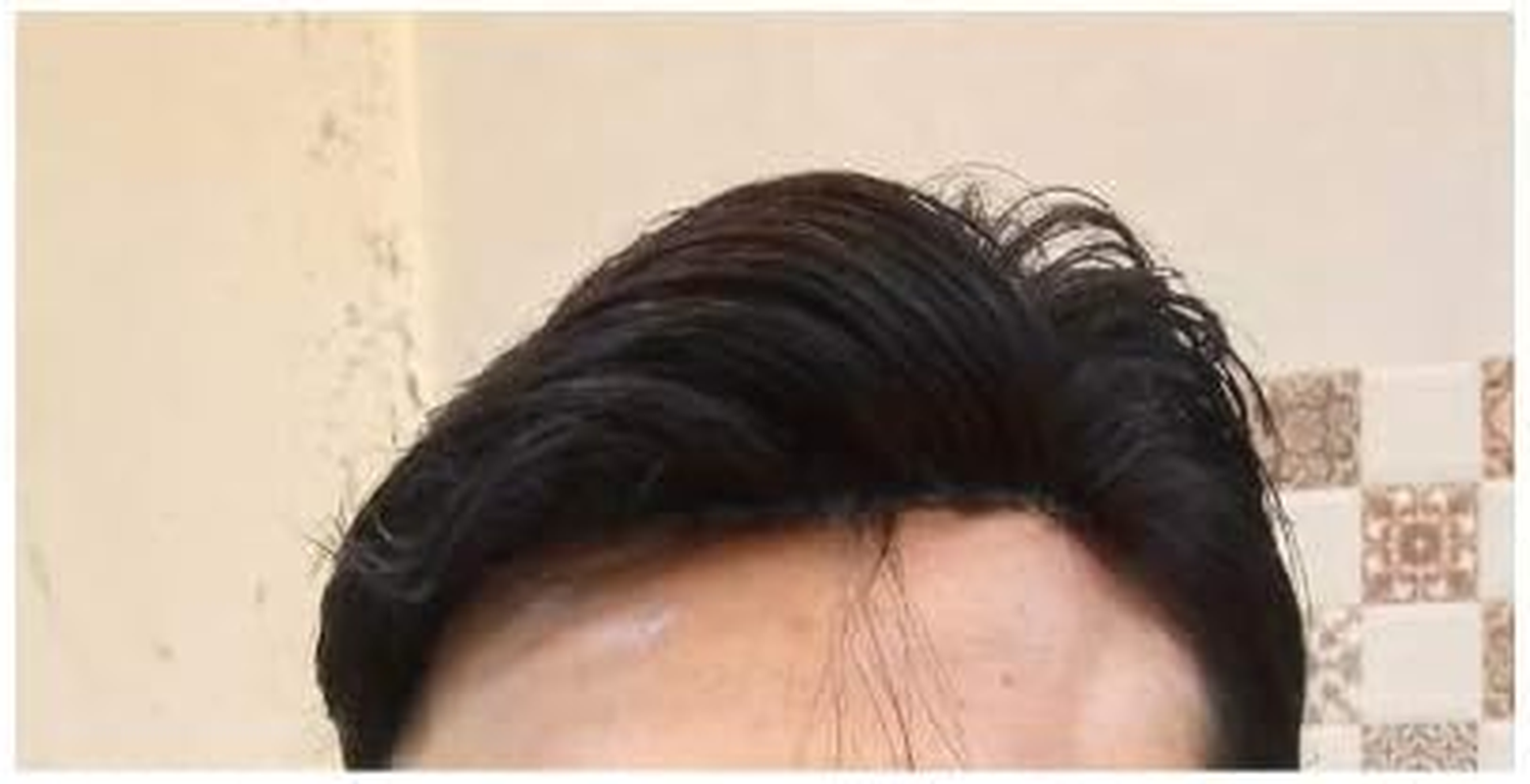 Mono Filament Hair Patch 100% Human Hair Nicely Process with Silky Hair image number 1