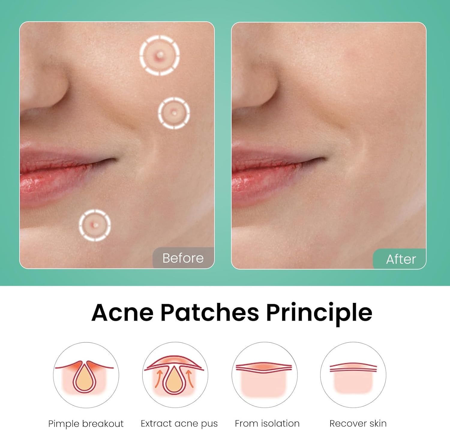 Nozibye 443Pcs Acne Patch Translucent Hydrocolloid Pimple Patches for Full-Face Blemish Care-Gently Absorbs Gunk- Strong Adhesion-Shields Skin-Ultra-Thin & Cozy-Day & Night Use - Sensitive Skin Safe - Premium Hydrocolloid - 5 Size Pack image number 4