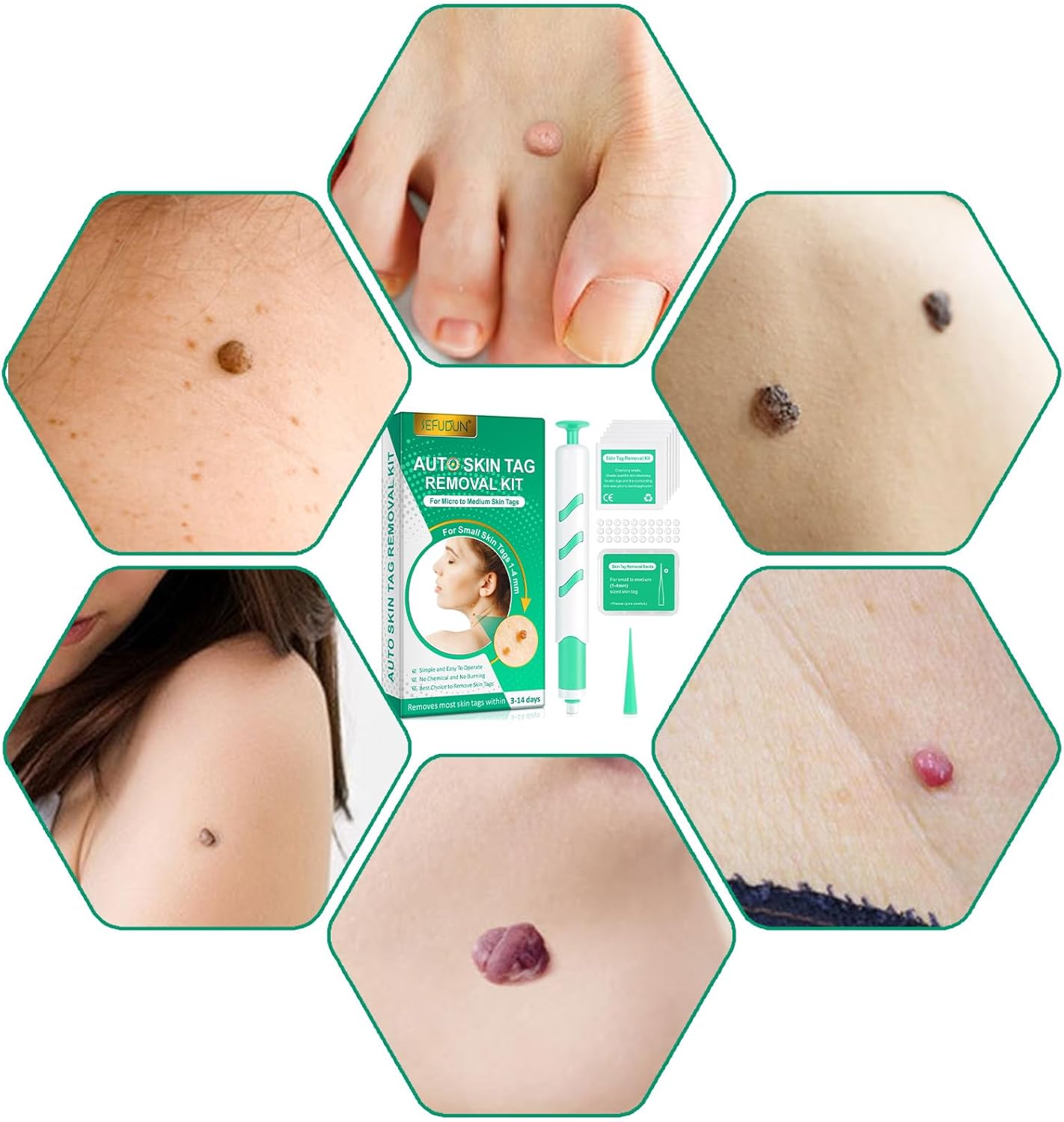 Skin Tag Remover Pen, 2-In-1 Standard Wart Remover, Skin Tag Removal, with 36 Repair Patches and Wet Wipes, Small Rubber Ring Suitable for Skin Tags Ranging from 1 Mm to 4 Mm in Size image number 6