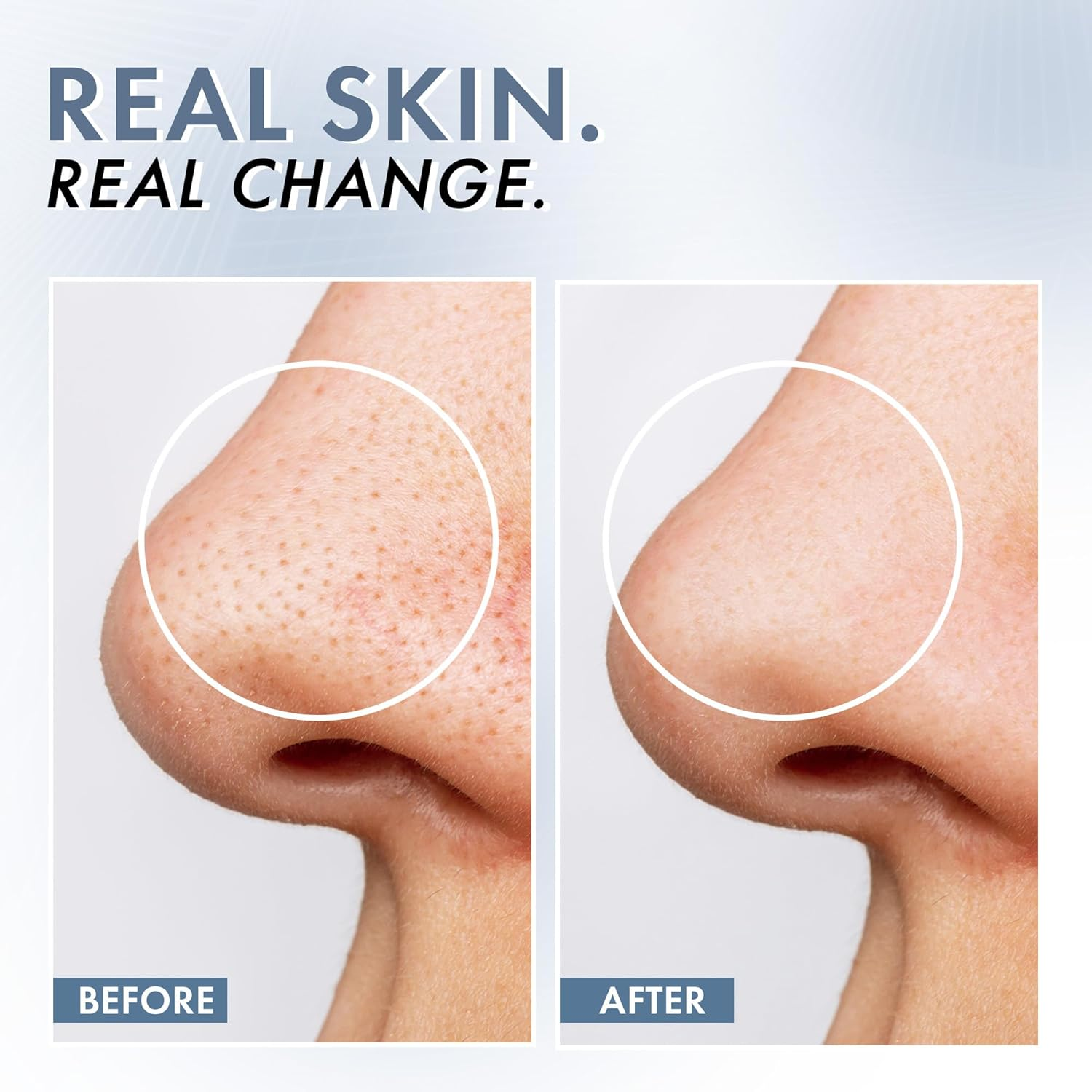 Thriveco Niacinamide Serum with Zinc PCA | Reduces Acne Marks & Blemishes | Minimizes Pores | Oil Control Face Serum for Oily Skin | for Men & Women | 30Ml image number 2