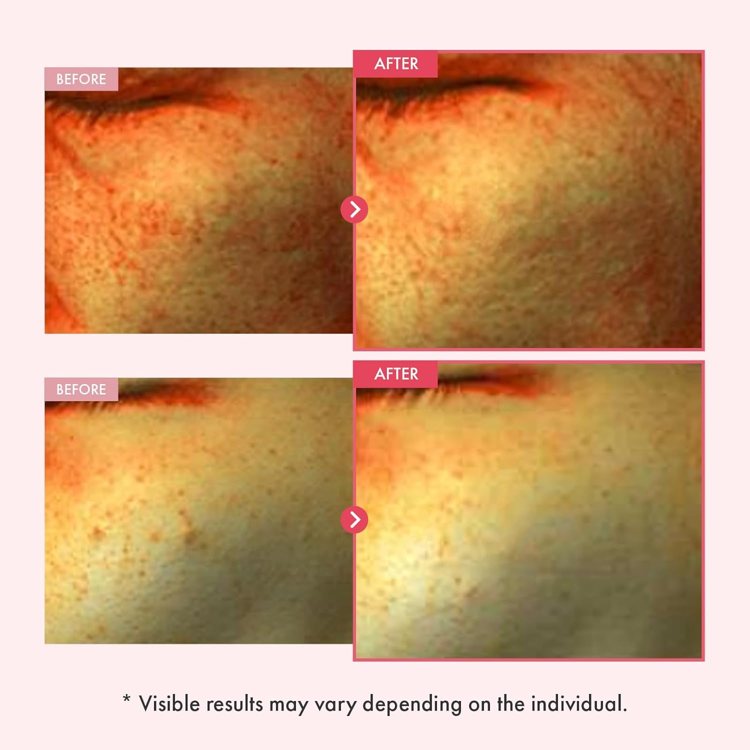 TOSOWOONG Niacinamide 10% Arbutin 7% Serum, Hyperpigmentation, Dark Spot Remover, Discoloration Correcting for Uneven Skin Tone, Glass Skin, All Skin Types, Korean Skincare, 33Ml / 1.11 Fl. Oz. image number 3