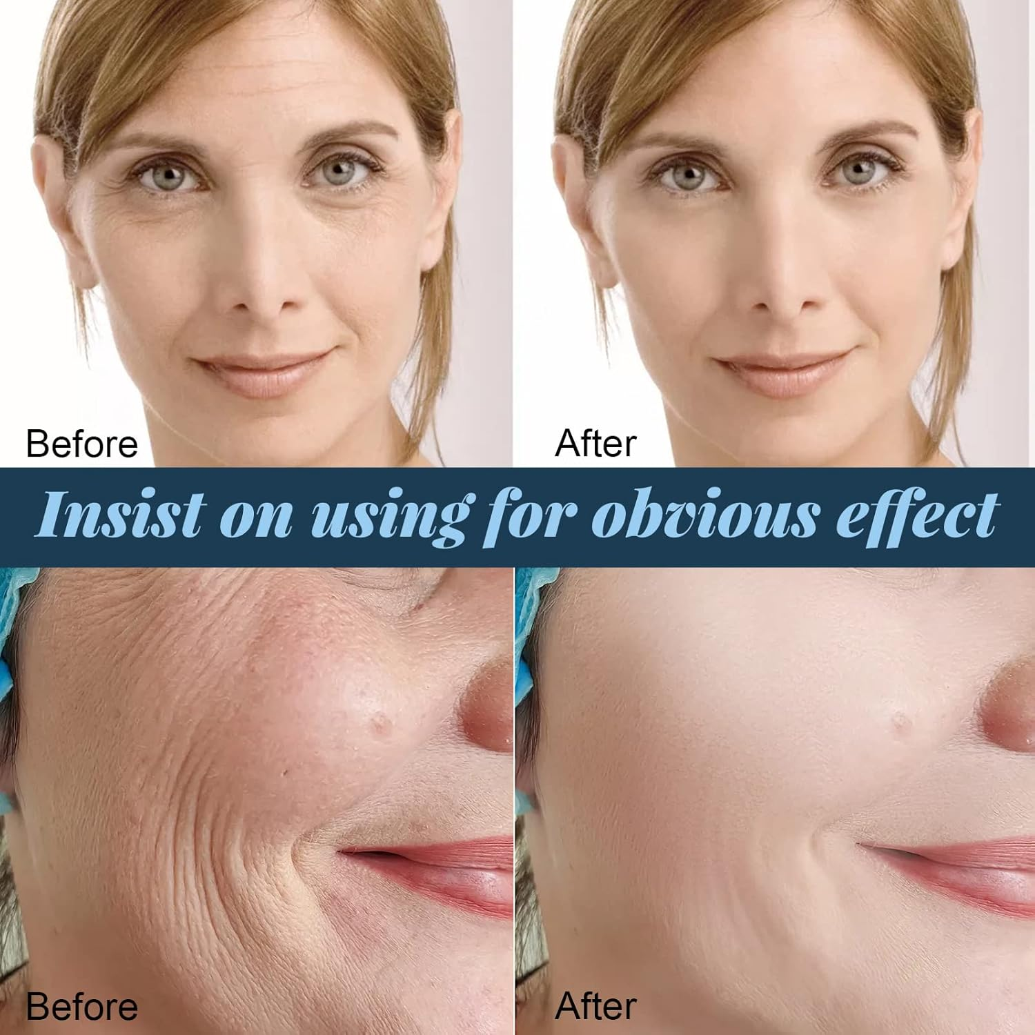 Protein Lift Line Skin -Wrinkle V-Face Firming Lifting Sagging Facial Contour ALKOY image number 2