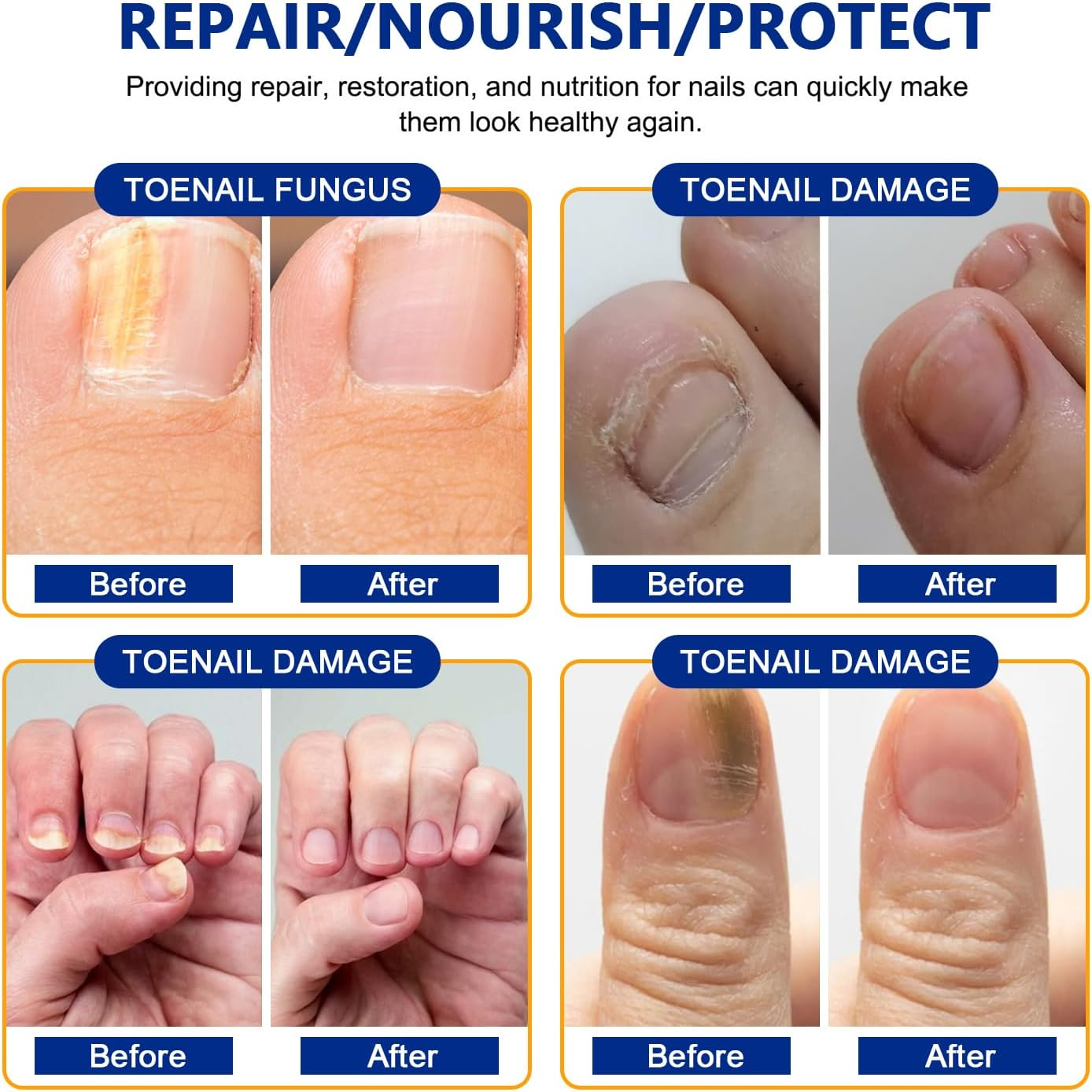 42 PCS Fungal Nail Patches, Toenail Treatment Patch, Nail Repair for Damaged Nails, Restore Discoloration and Thickness, Suitable for Both Men and Women image number 1