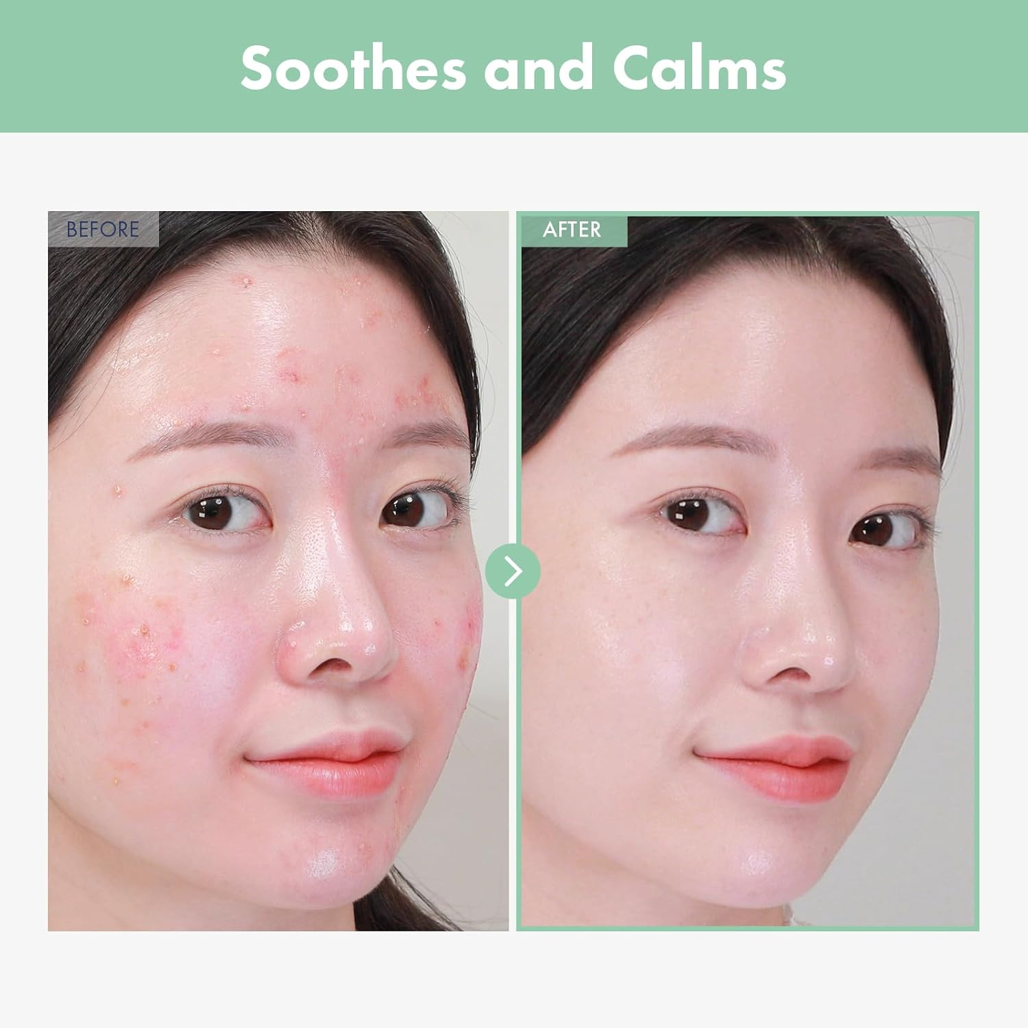 NATUREONE AC Kill Cream, BHA & Salicylic Acid Face Moisturizer, Niacinamide for Active Skin Repair, Tea Tree Oil for for Soothing Sensitive Skin, Acne Spot Treatment Korean Skincare, 30G, 1.05 Oz.