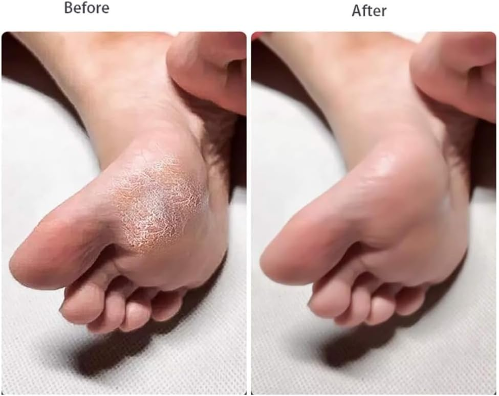 4 Pack Double Sided Foot File Callus Remover Pedicure Tool Dead Skin Scrubber Heel Exfoliator Foot Rasp Hard Skin Remover Plastic Sandpaper Foot Care Tool